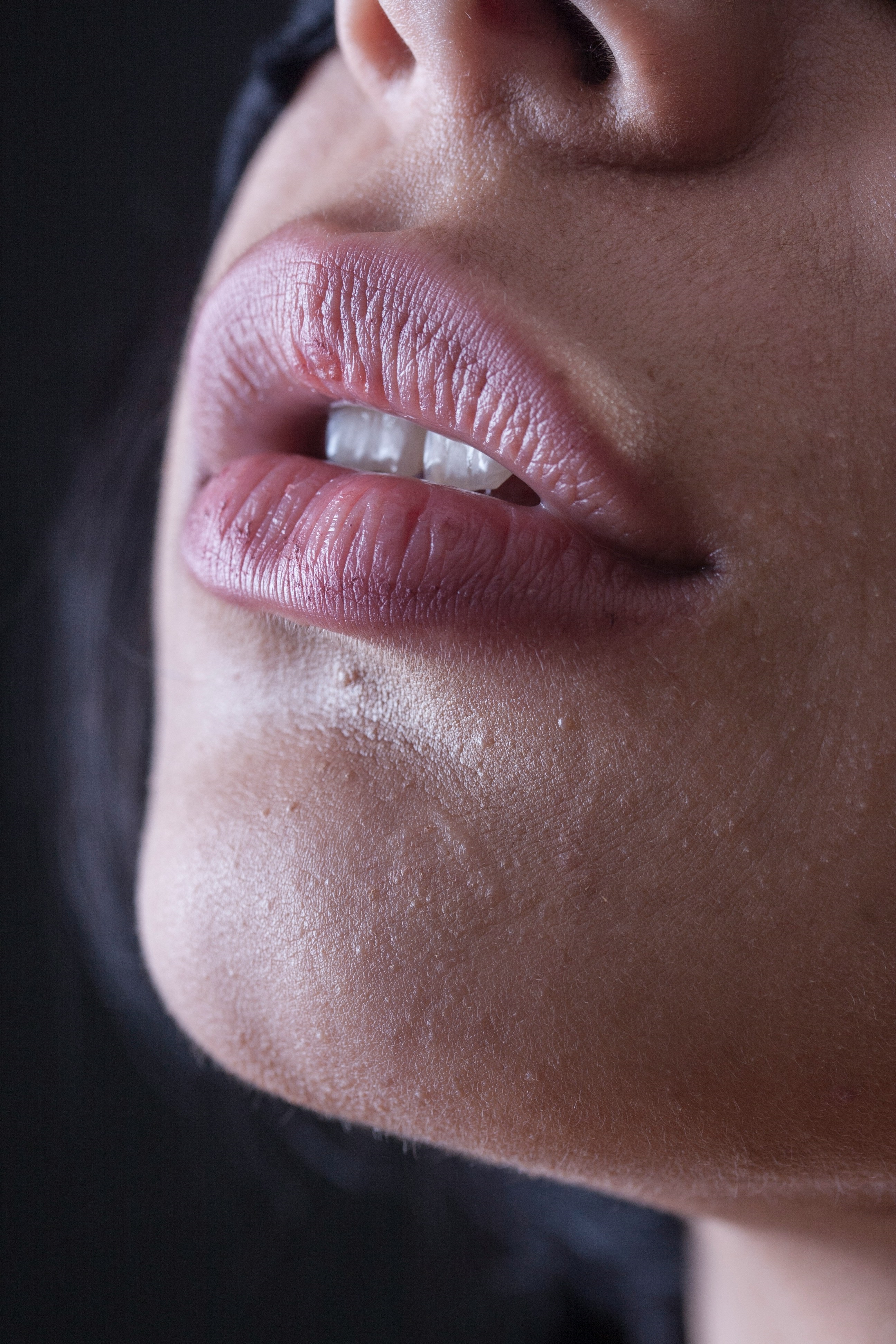 Lip flip